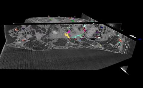Multiple areas of active fibrosis identified by microCT
