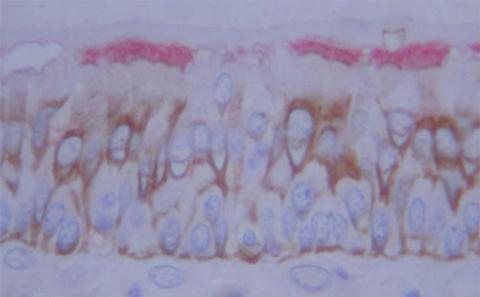 GMA section of nasal polyp double stained for beta tubulin (pink) and CBE-1 (brown) [Yoshisue H et al]