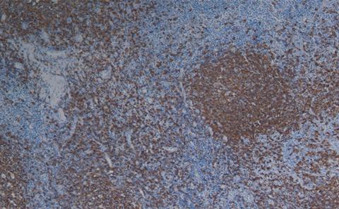 Paraffin section of tonsil stained by immunohistochemistry for CD20+ lymphocytes