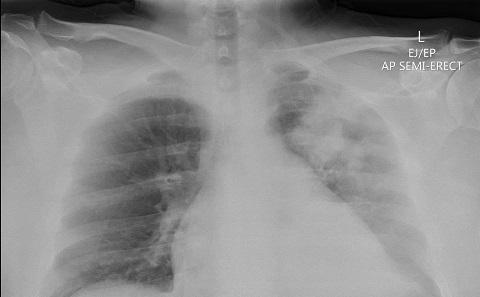 X-ray showing patch of pneumonia