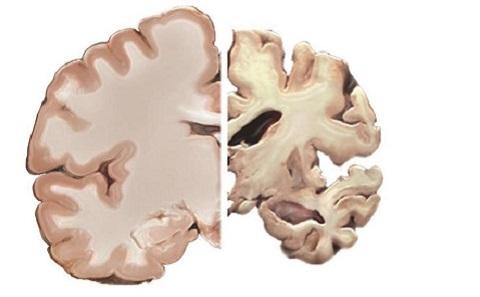 Image showing healthy brain vs. diseased brain