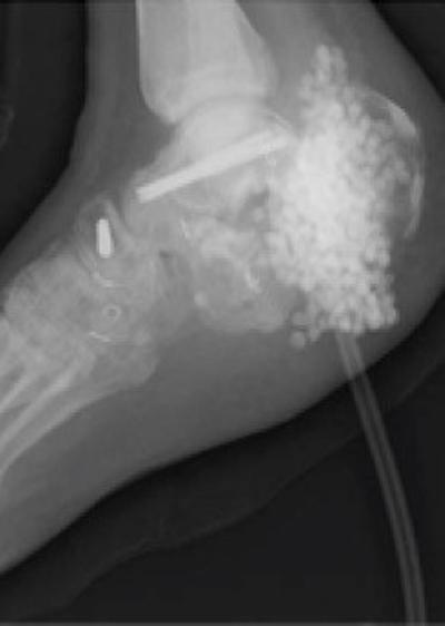 Xray of joint with antibiotic beads