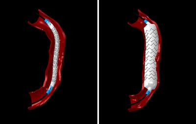 A balloon stent deployment within a patient specific right coronary artery