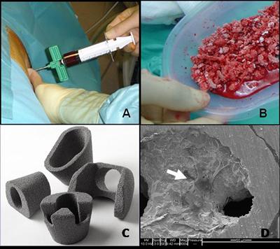 We applying tissue engineering principles to clinical bone grafting strategies to enhance bone formation, for example by supplementing graft with bone marrow cells (A and B) or applying trabecular met