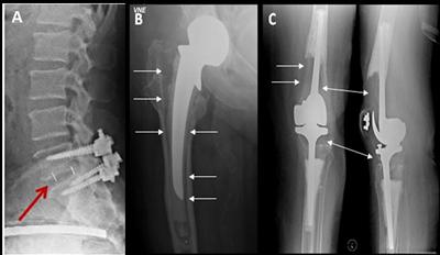 Key examples of the clinical need for bone regeneration strategies are spinal non-union (A) and revision hip (B) and knee (C) replacement  surgery. The arrows indicate areas of significant bone loss.