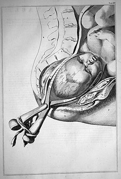 Forceps in Childbirth, William Smellie, 1754