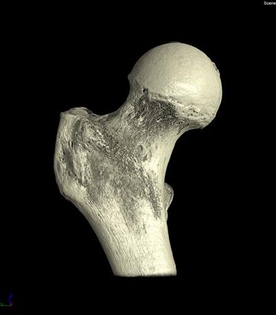 Three dimensional rendering of the proximal femur