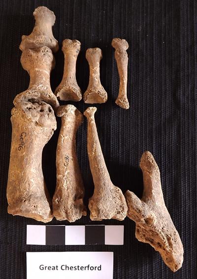 Foot bones of Great Chesterford skeleton show evidence of leprosy confirmed by DNA testing.