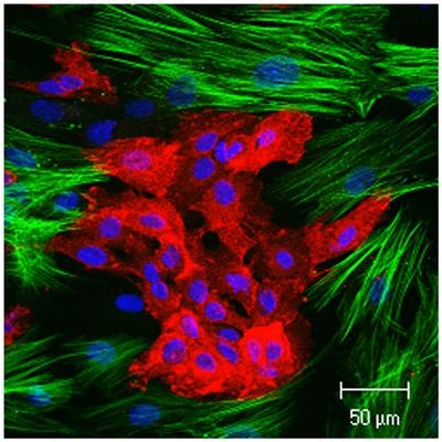 Figure shows a co-culture of alphavbeta6-expressing tumour cells (red) and smooth muscle actin-expressing myofibroblasts (green). Cell nuclei are shown in blue.