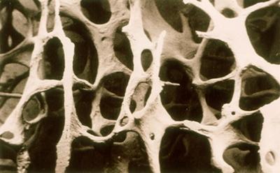 Osteoporotic fractures