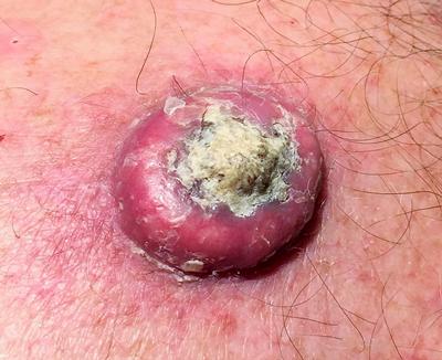 Skin cancer (seen here) is the most common cancer in the UK and worldwide.