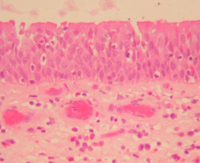 Paraffin section of nasal polyp stained with haematoxylin & eosin