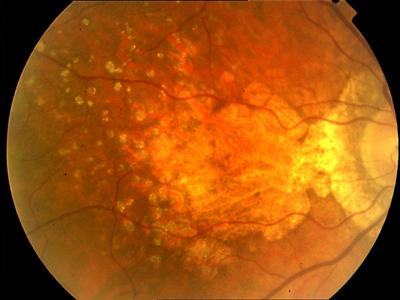 Retinal appearance of AMD