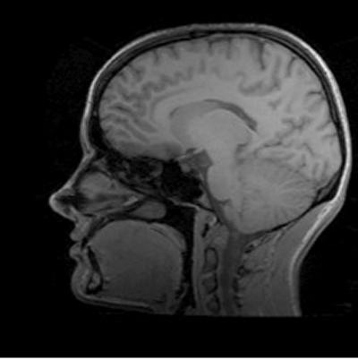 MRI image