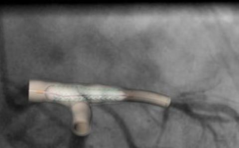 Simulation of stenting
