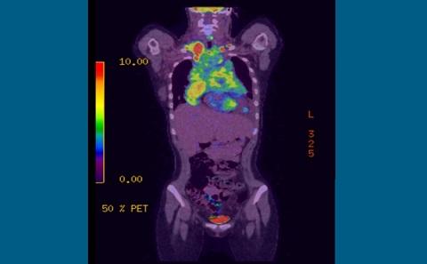 PET scan of someone with lymphoma
