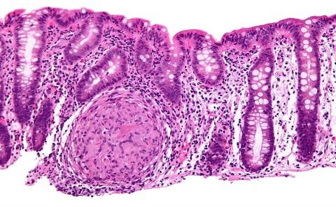 Histological view of inflammation in Crohn's disease