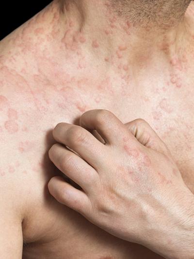 Chronic inflammatory skin diseases