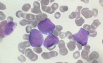 Picture of lymphoma cells