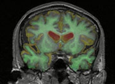 Brain scan showing Alzheimer's