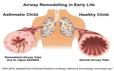 Airway remodelling in early life