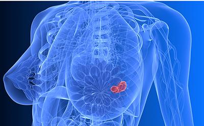 Breast cancer