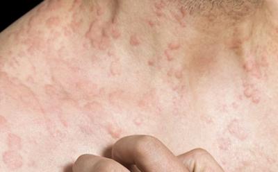 Education for skin conditions