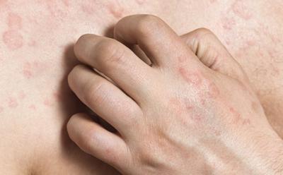 Skin diseases