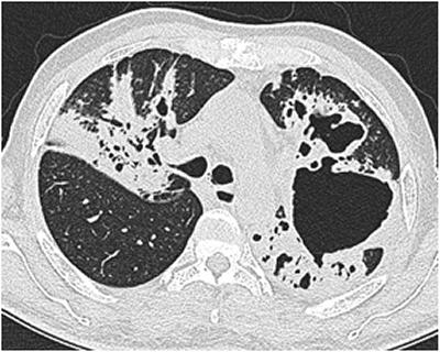 image shows lung destruction TB