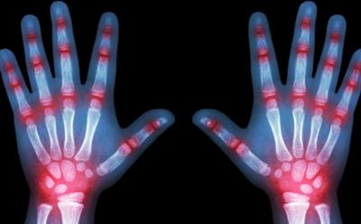 Juvenile idiopathic arthritis