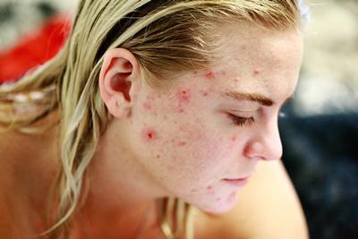 Photo of woman with acne
