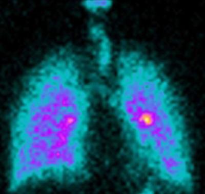 A Gamma Camera image of lungs