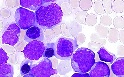 leukaemia cells