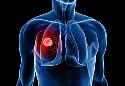 Lung cancer