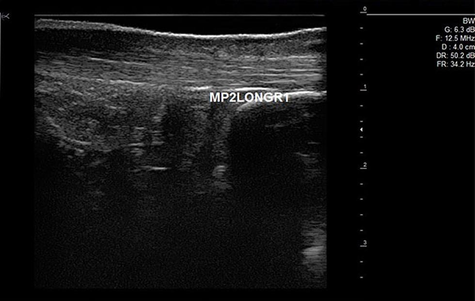 Ultrasound Image of Achilles’ Tendon
