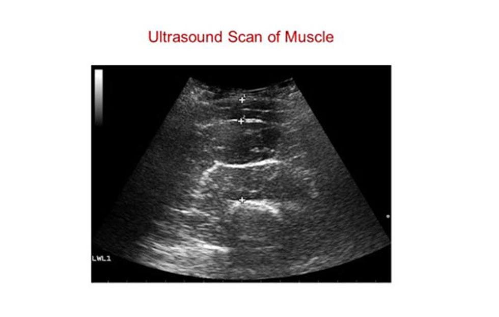 Ultrasound Image of Quadriceps