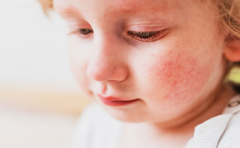 Image of a child with face rash