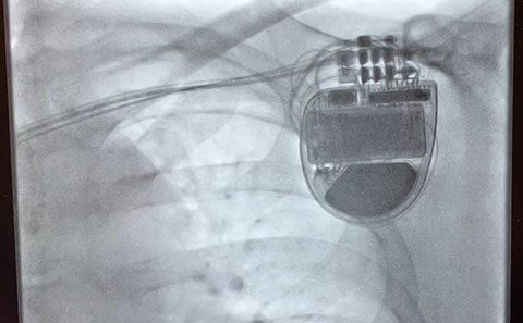 X-ray of ICD implant in patient's chest
