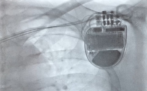 The implant in Phil's chest after surgery
