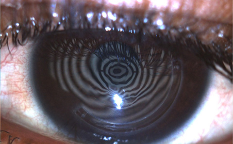 Placido disk reflected off eye with keratoconus