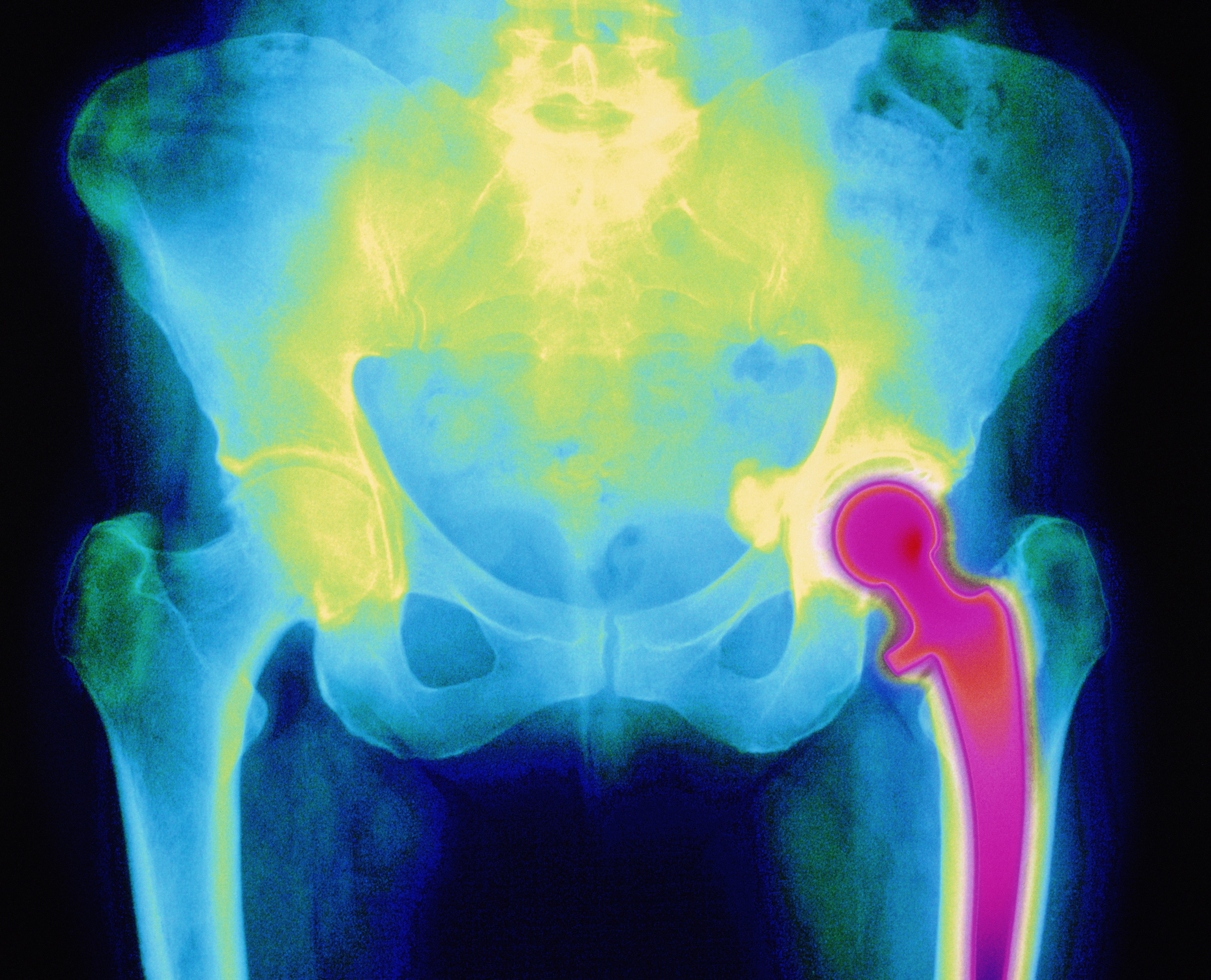 artificial hip joint