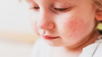 A close-up stock image of a young child with an outbreak of eczema on her cheek.